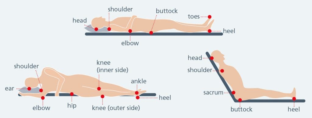 An image of body outlines showing areas of the body susceptible to pressure ulcers for aiding pressure ulcer care